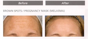 Before and after brown spots/pregnancy mask(melasma)