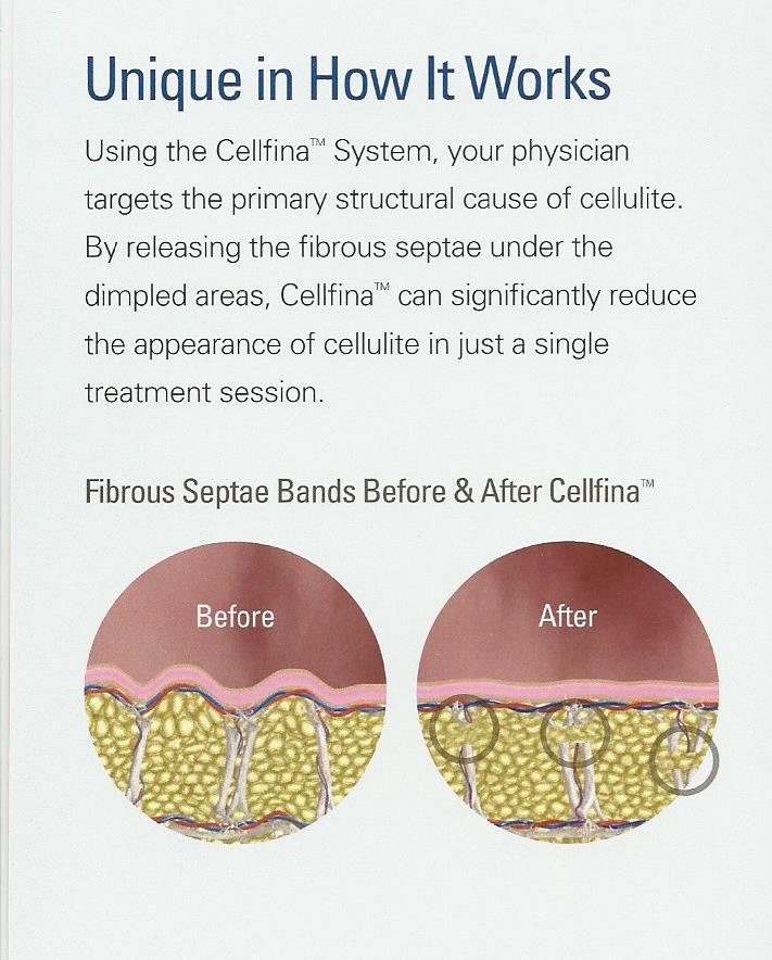 Before and After Cellfina image