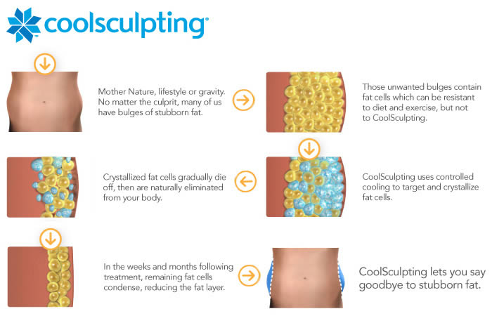 The Coolsculpting process