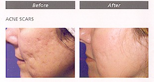 Before and after removing acne scars