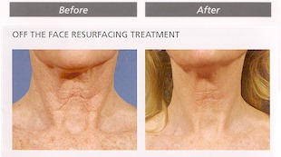 Before and after neck resurfacing treatment