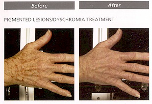 Before and after pigmented lesions'dyschromia treatment