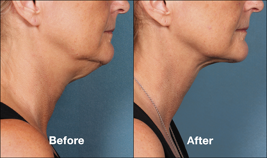 Client before and after Kybella treatment