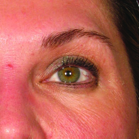 Brow after ultherapy