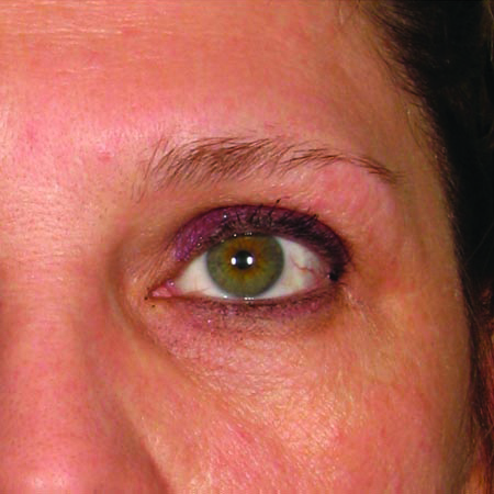 Brow before ultherapy