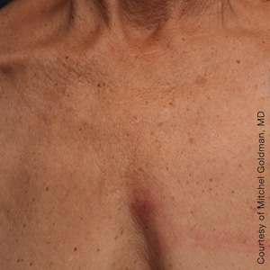 After ultherapy on chest