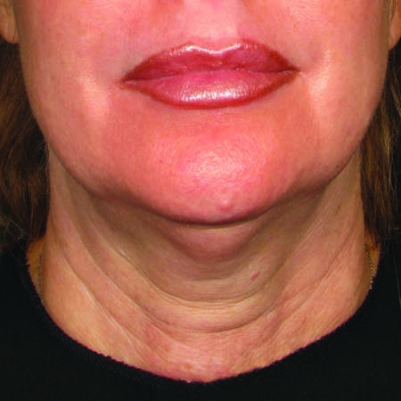 Before ultherapy for lower face