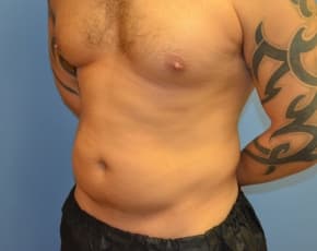 Abdominal Etching Before & After Photos | Associates in Plastic Surgery