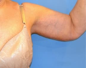 Arm Lift Before & After Photos | Associates in Plastic Surgery