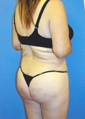 Brazilian Butt Lift Before & After Photos | Associates in Plastic Surgery