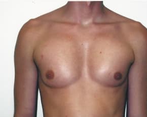 Implants For Bodybuilding Before & After Photos | Associates in Plastic Surgery