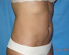 Liposuction And Smartlipo Before & After Photos | Associates in Plastic Surgery