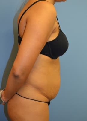 Tummy Tuck Before & After Photos | Associates in Plastic Surgery