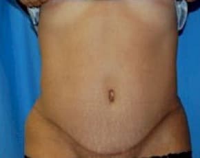 Tummy Tuck Before & After Photos | Associates in Plastic Surgery