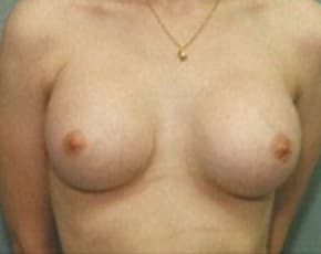 Breast Augmentation Before & After Photos | Associates in Plastic Surgery