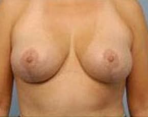 Breast Lift And Reduction Before & After Photos | Associates in Plastic Surgery