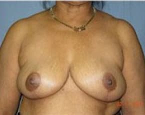 Breast Lift And Reduction Before & After Photos | Associates in Plastic Surgery