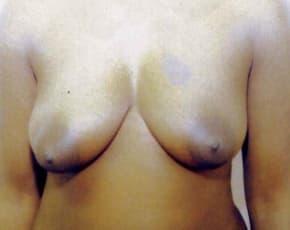 Breast Lift With Implants Before & After Photos | Associates in Plastic Surgery