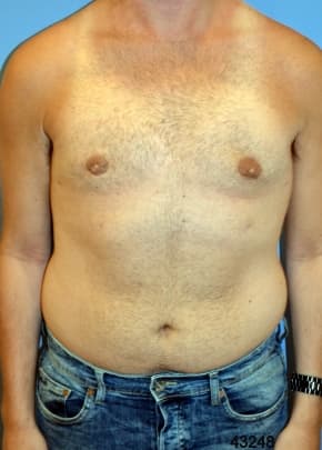 Male Breast Reduction Before & After Photos | Associates in Plastic Surgery