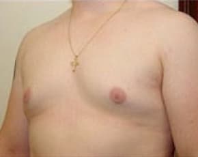 Male Breast Reduction Before & After Photos | Associates in Plastic Surgery