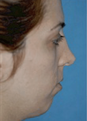Chin And Cheek Implants Before & After Photos | Associates in Plastic Surgery