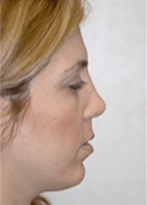 Chin And Cheek Implants Before & After Photos | Associates in Plastic Surgery