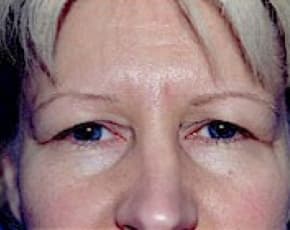 Eyelid Surgery Browlift Before & After Photos | Associates in Plastic Surgery