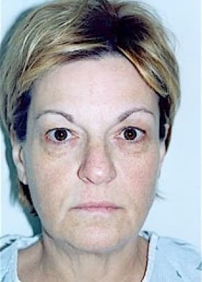 Eyelid Surgery Browlift Before & After Photos | Associates in Plastic Surgery