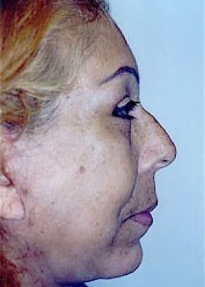 Facelift And Mini Facelift Before & After Photos | Associates in Plastic Surgery