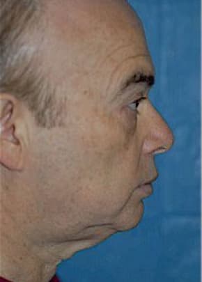 Facelift And Mini Facelift Before & After Photos | Associates in Plastic Surgery