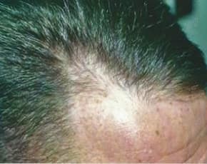 Hair Transplant Before & After Photos | Associates in Plastic Surgery