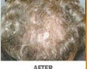 Hair Transplant Before & After Photos | Associates in Plastic Surgery