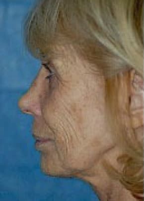 Laser Wrinkle Removal Before & After Photos | Associates in Plastic Surgery