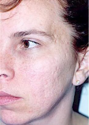 Laser Wrinkle Removal Before & After Photos | Associates in Plastic Surgery
