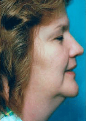 Necklift And Necklipo Before & After Photos | Associates in Plastic Surgery