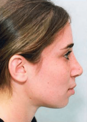 Rhinoplasty Before & After Photos | Associates in Plastic Surgery