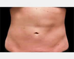 Coolsculpting Before & After Photos | Associates in Plastic Surgery