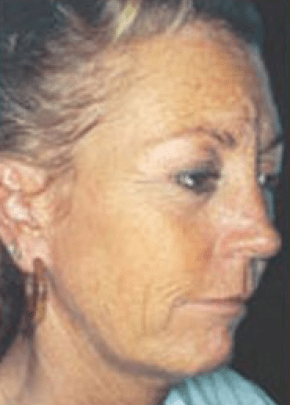 Skin Peels Before & After Photos | Associates in Plastic Surgery
