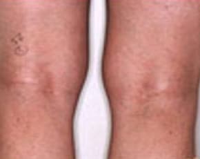 Spider Vein Removal Before & After Photos | Associates in Plastic Surgery