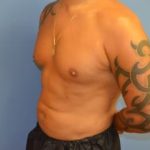 Abdominal Etching Before & After Patient #1245