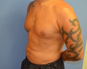 Abdominal Etching Before & After Patient #1245