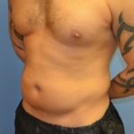 Abdominal Etching Before & After Patient #1245
