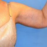 Arm Lift Before & After Patient #1214