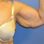 Arm Lift Before & After Patient #1214