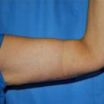 Arm Lift Before & After Patient #1212