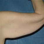 Arm Lift Before & After Patient #1212