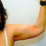 Arm Lift Before & After Patient #1211