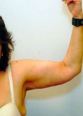Arm Lift Before & After Patient #1211