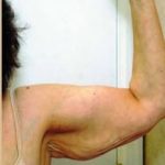Arm Lift Before & After Patient #1211