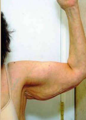 Arm Lift Before & After Patient #1211